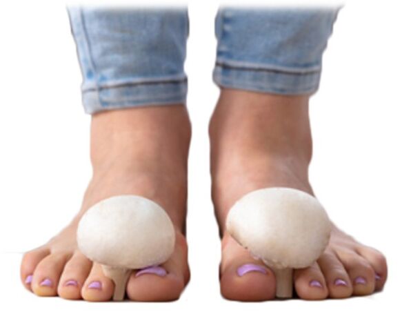 Grzybica powierzchni stopy i paznokci