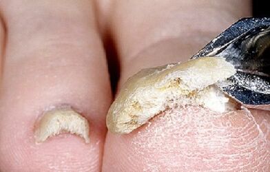 zaawansowane stadium zakażenia grzybicą paznokci nail