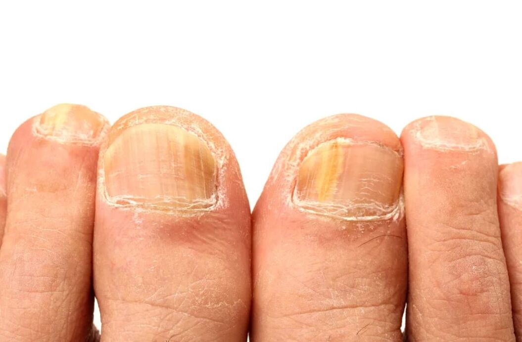 przyczyny grzybicy paznokci