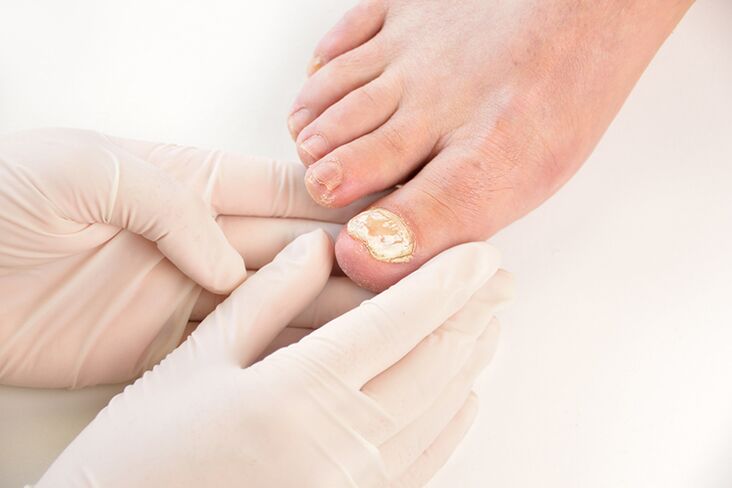 Przed przepisaniem leczenia lekarz musi zdiagnozować grzybicę paznokci