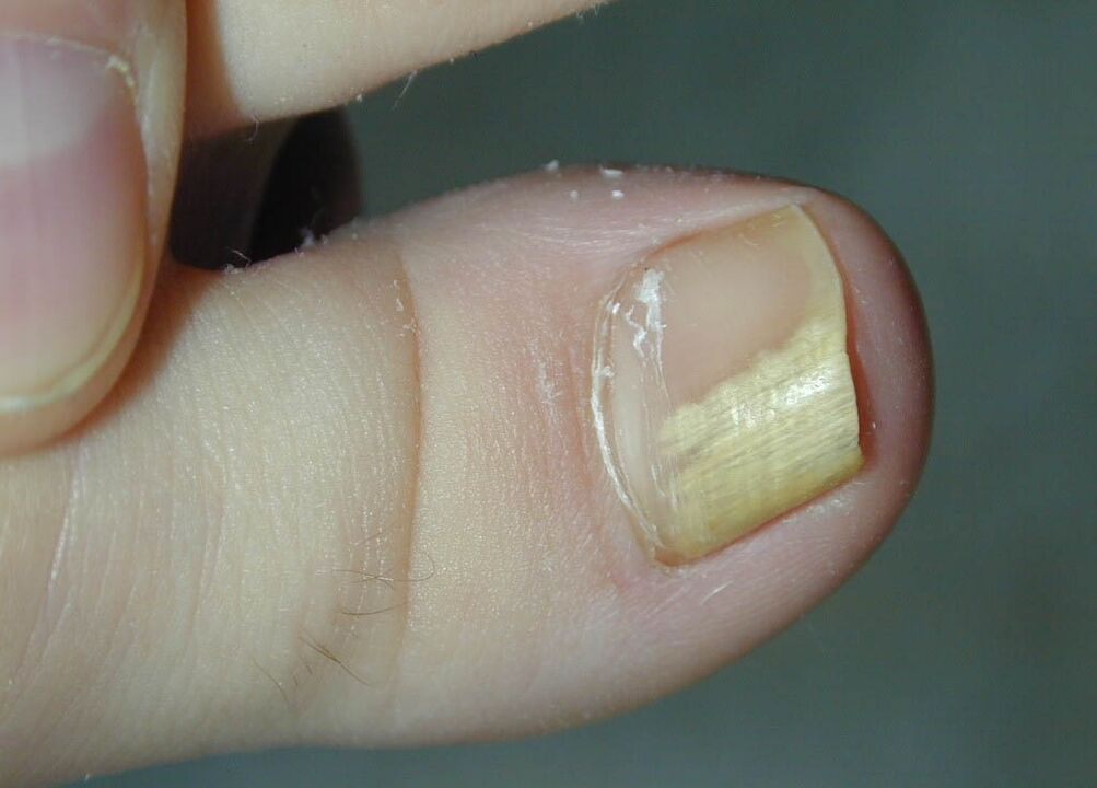grzybica płytki paznokcia