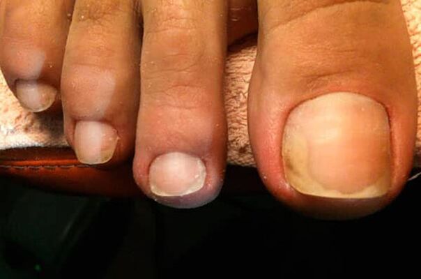 Grzybica paznokci zaczyna się od dużego palca u nogi