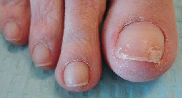 Jednym z objawów grzybicy paznokci jest odklejanie się płytki paznokcia. 