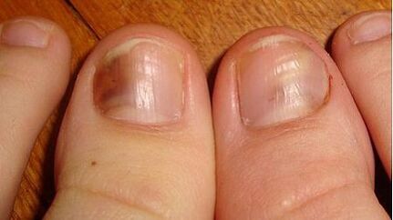 Oznaką grzybicy jest ciemnienie płytki paznokcia