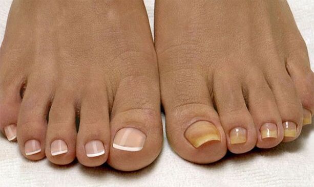 Zdrowe paznokcie u stóp (po lewej) i dotknięte grzybicą (po prawej)