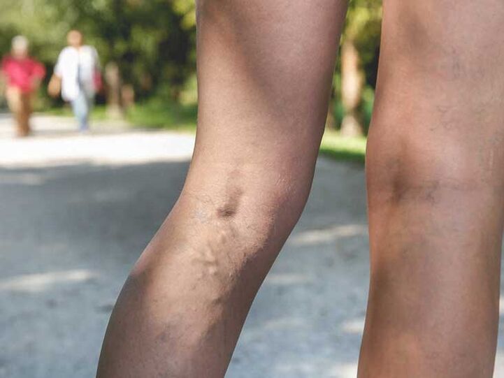 Żylaki są czynnikiem ryzyka infekcji grzybiczej stóp