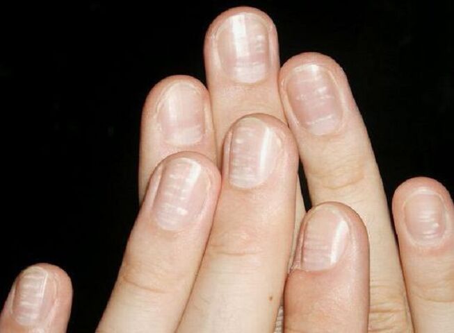Białe plamki na paznokciach są oznaką rozwoju grzyba