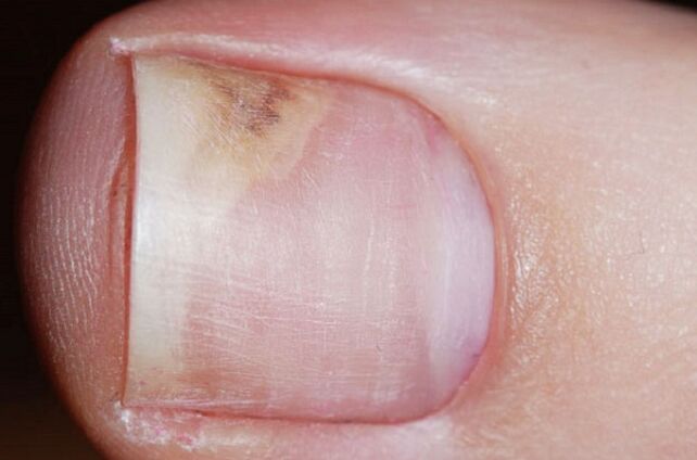 Objawy grzybicy paznokci na początkowym etapie - brak połysku, szczelina między paznokciem a łóżkiem