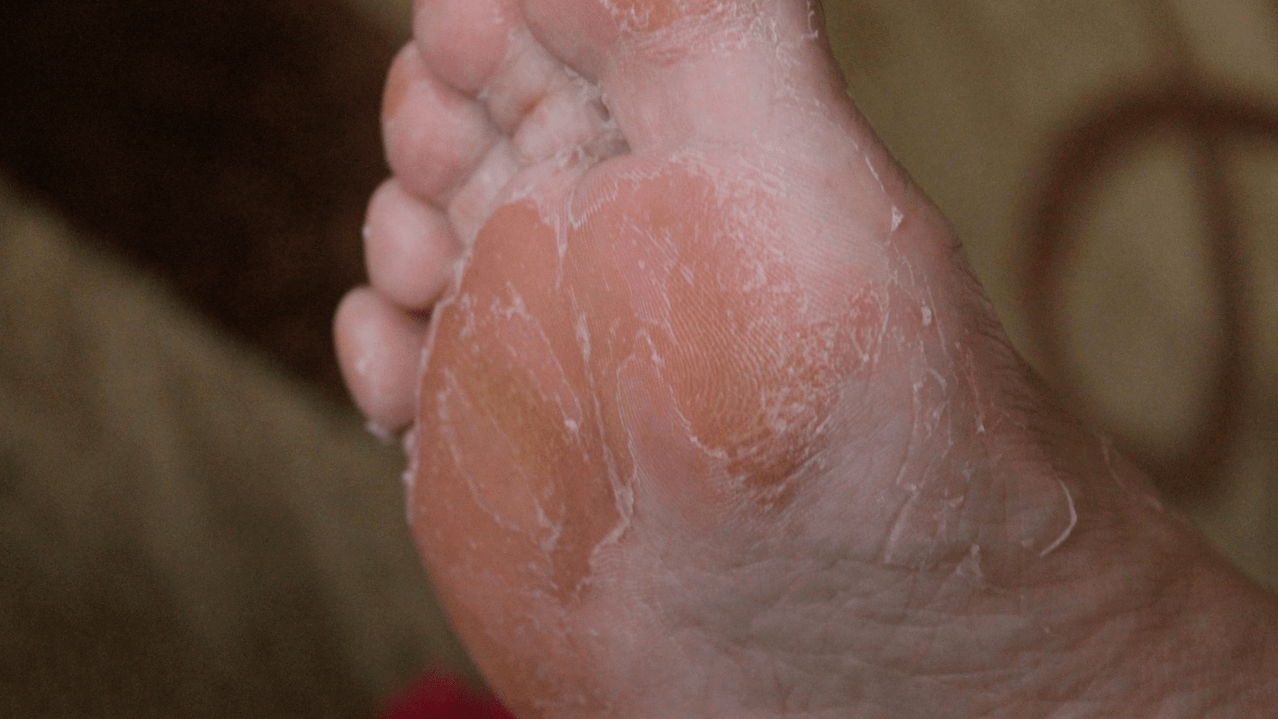 grzybica skóry stóp
