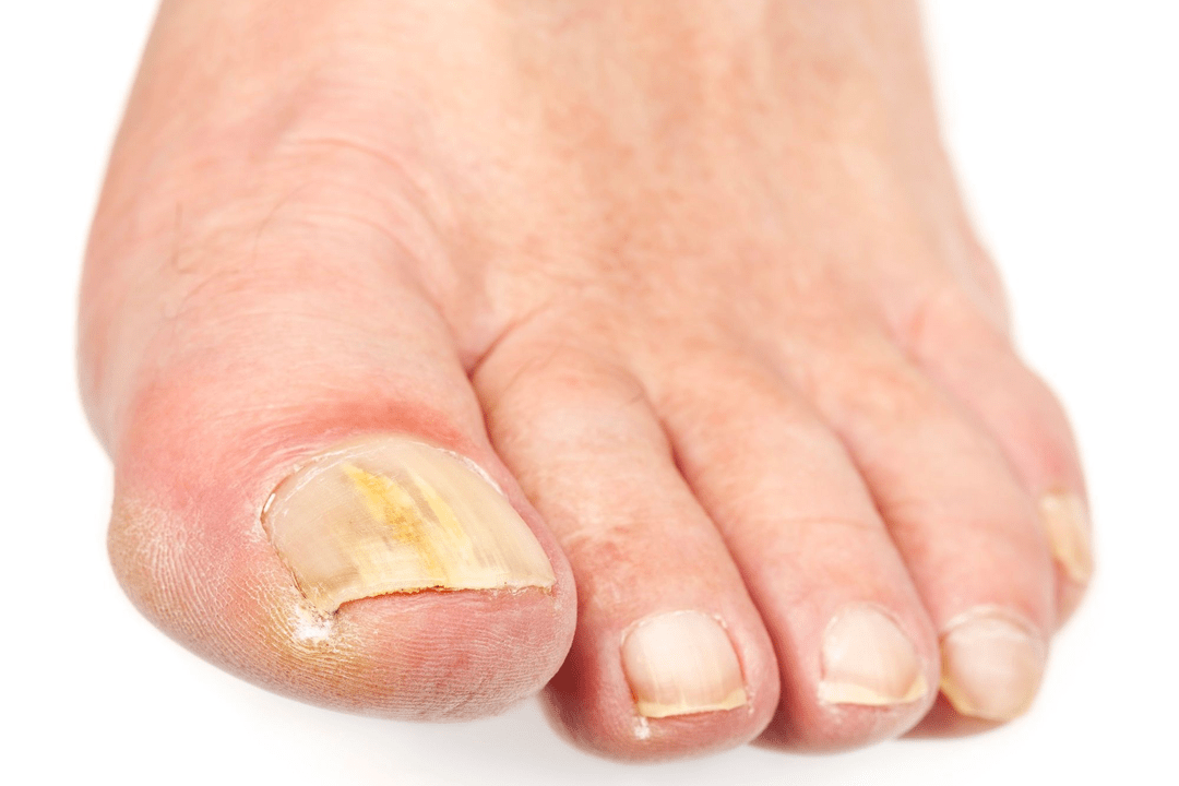 infekcja grzybicza płytek paznokciowych