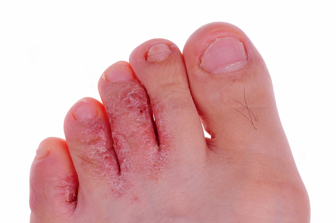 infekcja grzybicza skóry między palcami