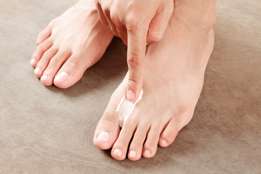 nałożenie maści przeciwgrzybiczej na skórę stóp