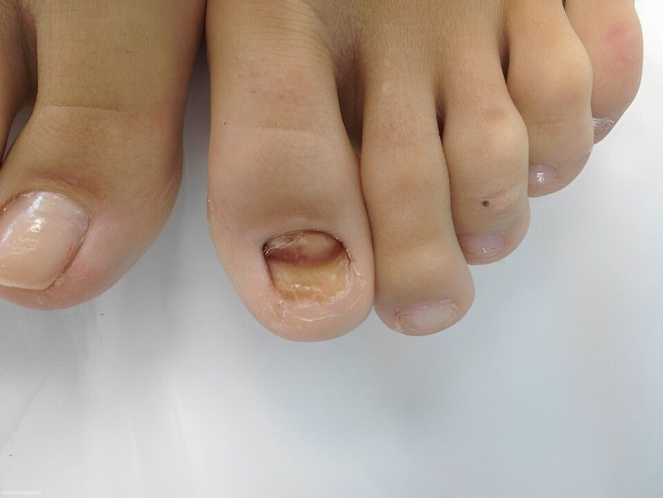 grzybicza choroba paznokci