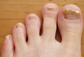Runded onychomycosis