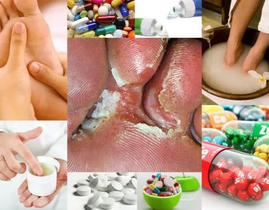 Grzybica międzypalcowa i metody leczenia