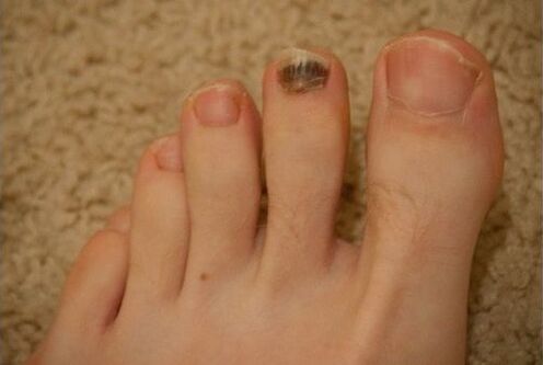 Stosowanie leków doustnych i miejscowych