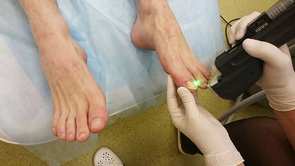 laseroterapia grzybicy paznokci