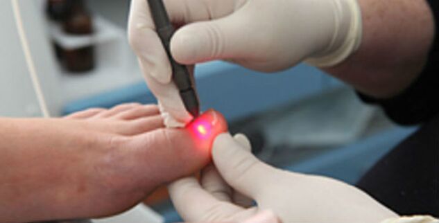 Laseroterapia grzybicy paznokci
